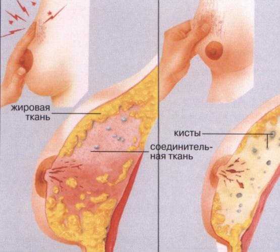 Как лечить кисту в груди народными методами Как лечить кисту в груди народными методами