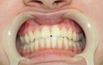 Разновидности кист челюсти и возможные осложнения