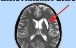 Как лечить ретроцеребеллярную кисту головного мозга, какие размеры могут быть опасны
