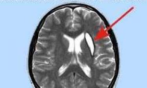 Как лечить ретроцеребеллярную кисту головного мозга, какие размеры могут быть опасны