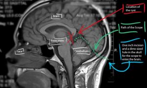 Симптомы и методы лечения кисты головного мозга у взрослых