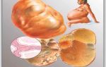 Причины образования муцинозной кисты яичника и методы её лечения