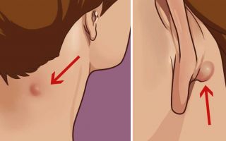 Основные симптомы и методы лечения кисты на ухе