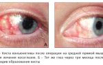 Варианты лечения кисты глаза и возможные осложнения