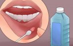 Причины появления и лечение ретенционной кисты нижней губы