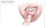 Причины появления и лечение кисты губы