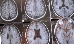 Могут ли быть последствия от кисты прозрачной перегородки головного мозга