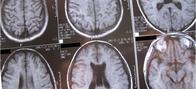 Могут ли быть последствия от кисты прозрачной перегородки головного мозга