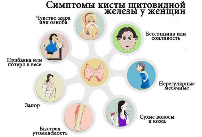 Симптомы кисты щитовидной железы у женщин