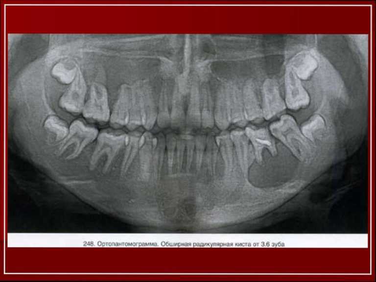 Одонтогенная киста фото
